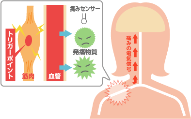 仙台でトリガーポイントによる施術を行う「はーと接骨院」